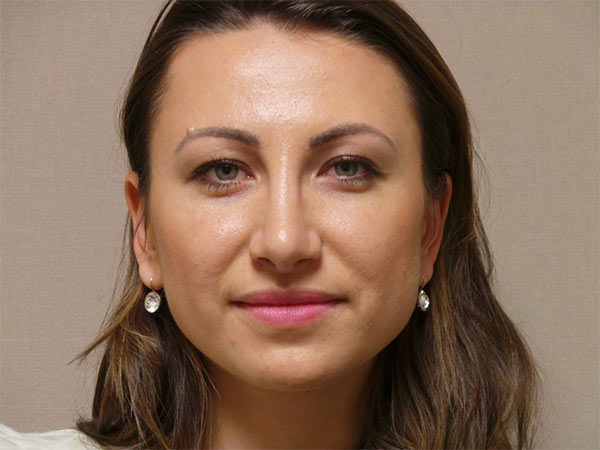 Rhinoplasty Patient 01 After 1