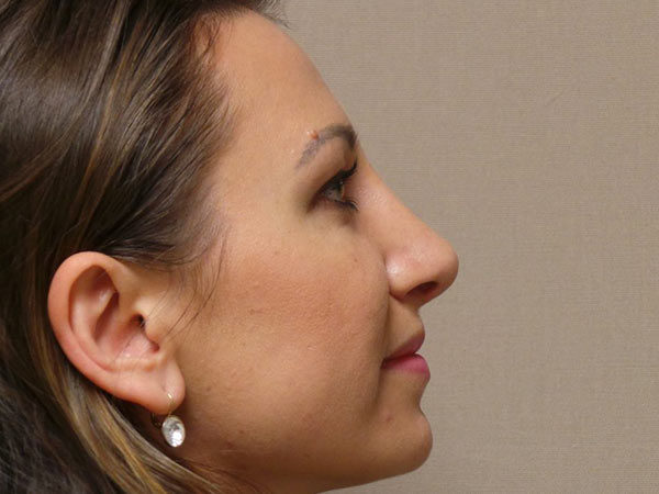 Rhinoplasty Patient 01 After 2