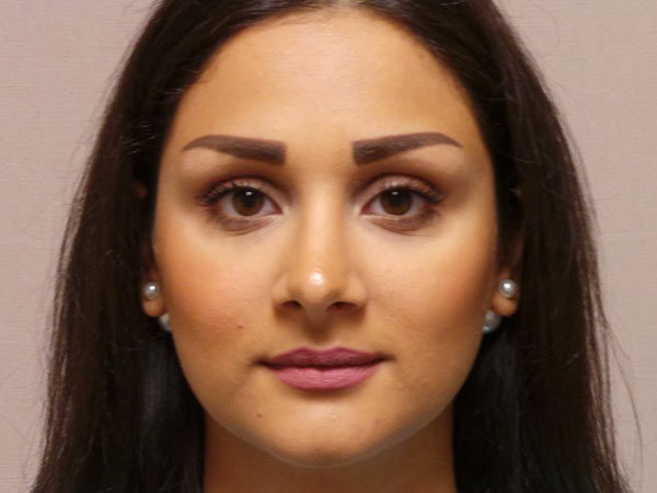 Rhinoplasty Patient 29 After 1