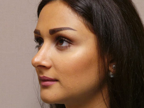 Rhinoplasty Patient 29 After 2