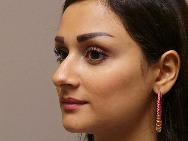 Rhinoplasty Patient 29 Before 2