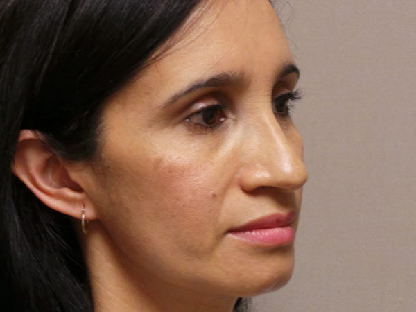 Rhinoplasty Patient 13 Before 2