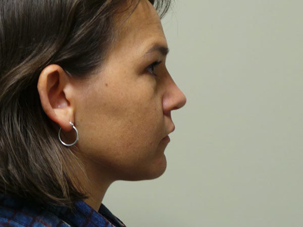 Rhinoplasty Patient 28 After 1