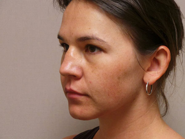 Rhinoplasty Patient 28 Before 2