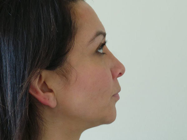 Rhinoplasty Patient 25 After 1