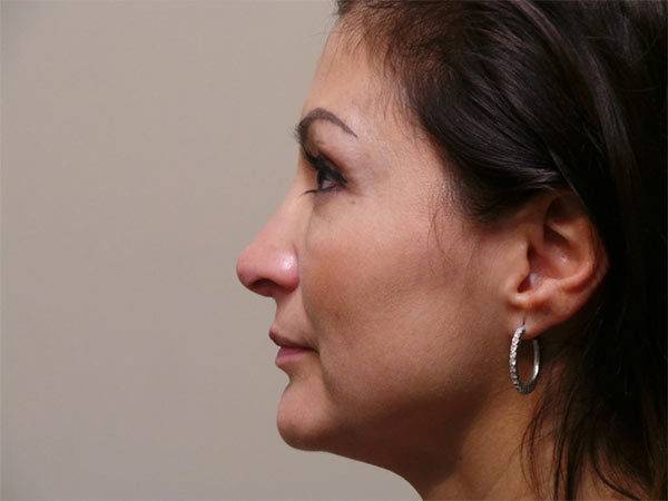 Rhinoplasty Patient 26 After 1