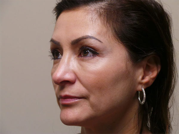 Rhinoplasty Patient 26 After 2