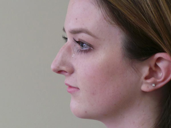 Rhinoplasty Patient 23 Before 1