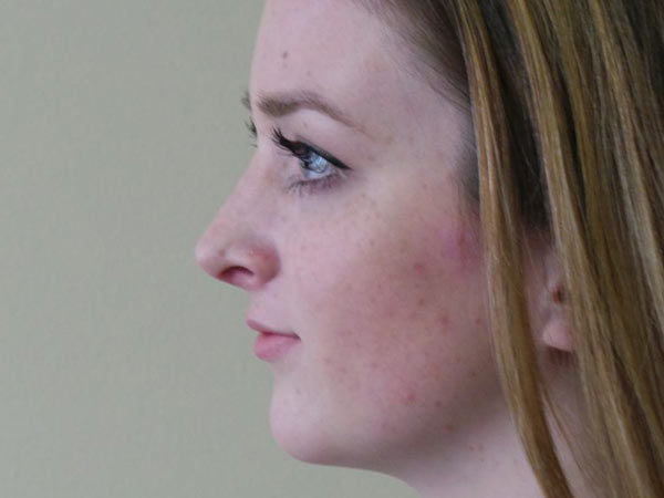 Rhinoplasty Patient 23 After 1