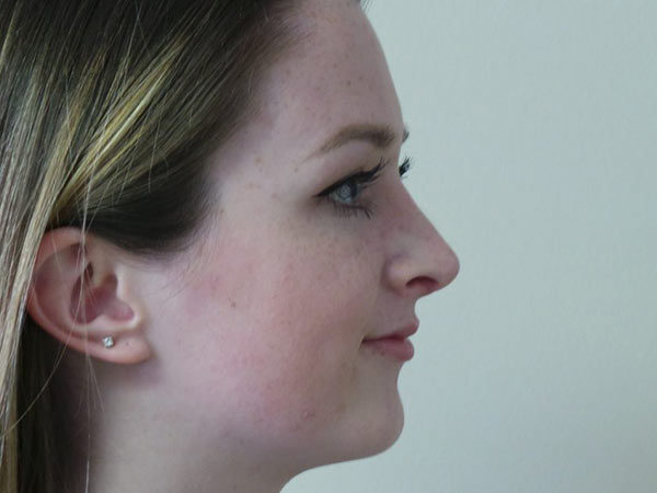 Rhinoplasty Patient 23 After 2