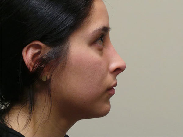 Rhinoplasty Patient 20 After 1