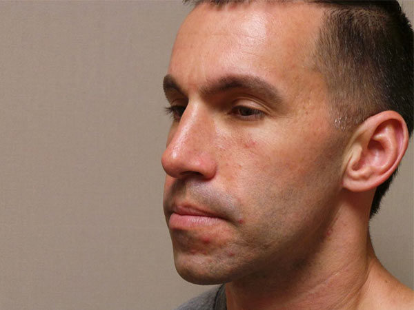 Rhinoplasty Patient 02 After 2