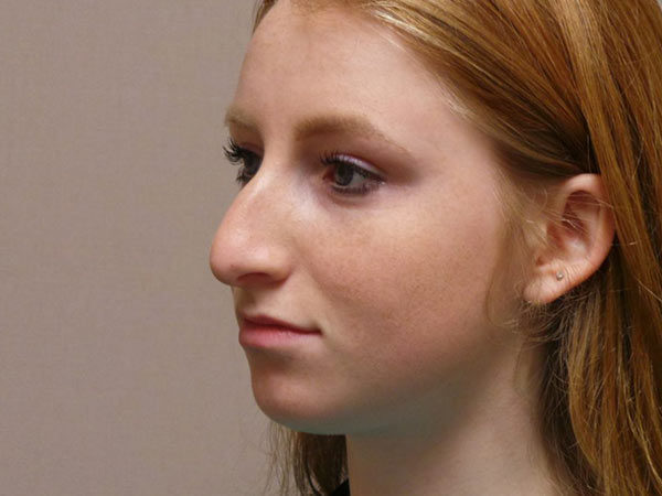 Rhinoplasty Patient 16 Before 2