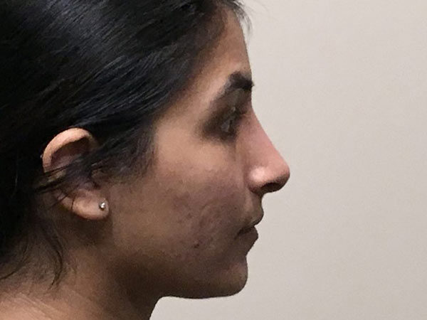Rhinoplasty Patient 17 After 1