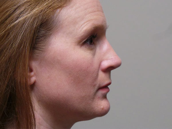 Rhinoplasty Patient 11 After 1