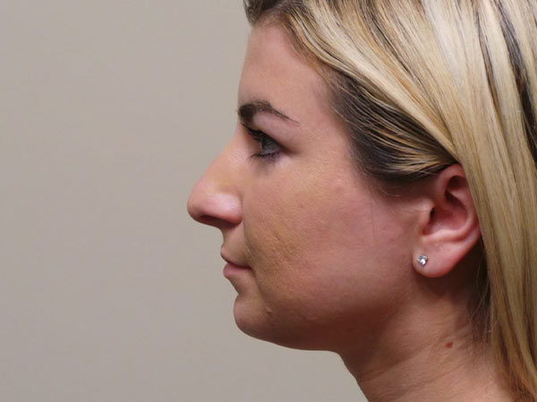 Rhinoplasty Patient 12 Before 1
