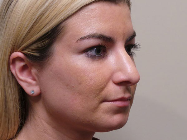 Rhinoplasty Patient 12 Before 2