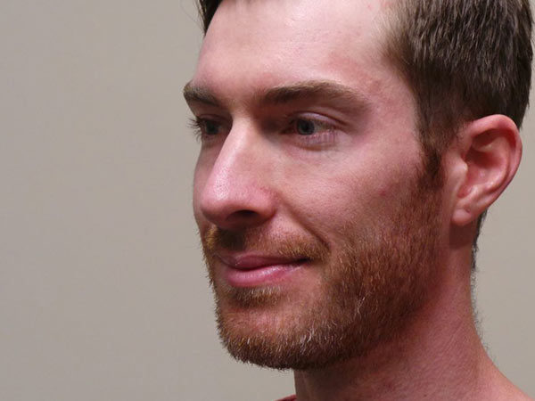 Rhinoplasty Patient 09 After 2