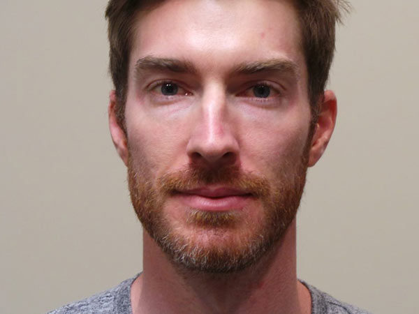 Rhinoplasty Patient 09 Before 1