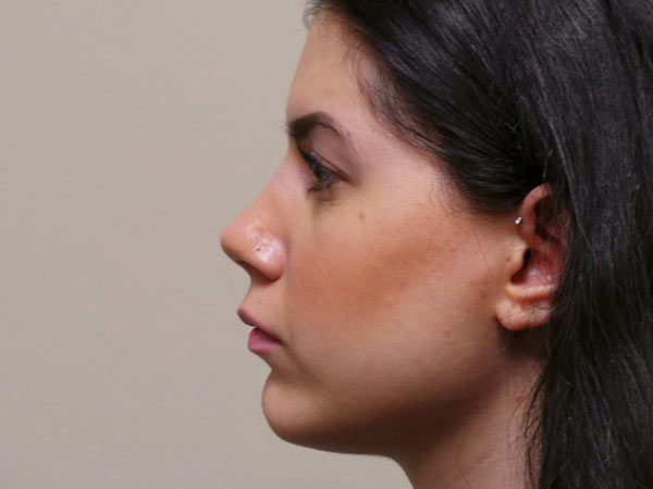 Rhinoplasty Patient 07 After 2