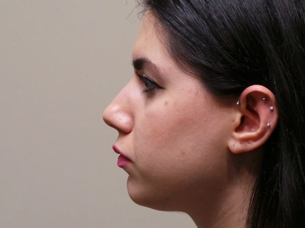Rhinoplasty Patient 07 Before 2