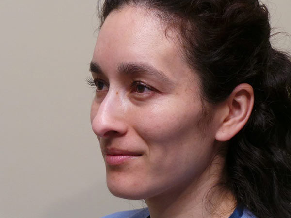 Rhinoplasty Patient 29 Before 1