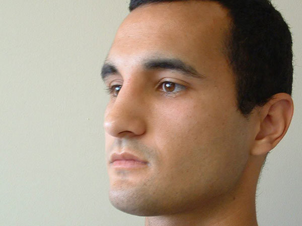 Rhinoplasty Patient 03 After 2