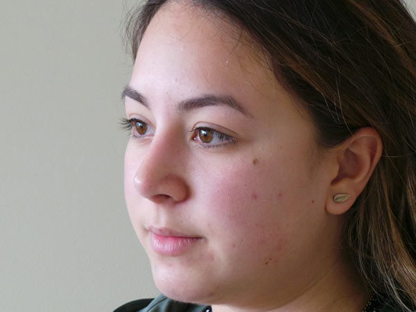 Rhinoplasty Patient 33 After 1