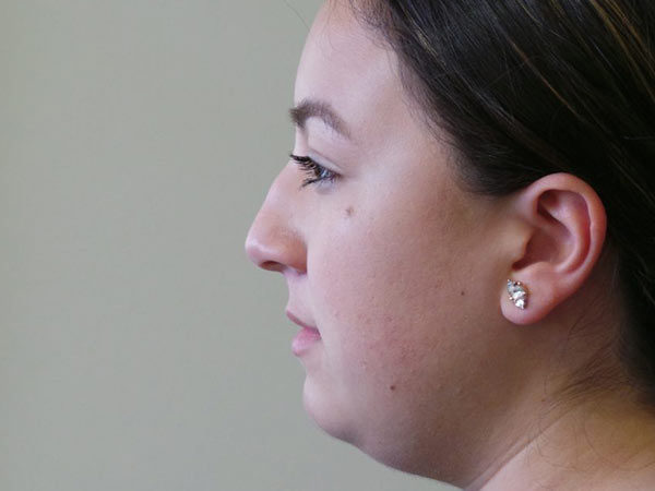 Rhinoplasty Patient 33 Before 2