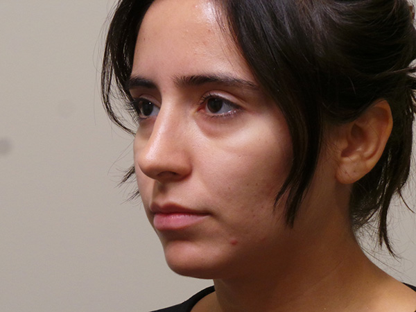 Rhinoplasty Patient 34 After 1