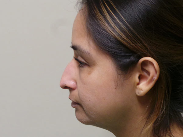 Rhinoplasty Patient 01 Before 2