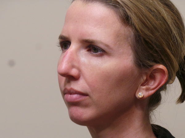 Rhinoplasty Patient 35 Before 1