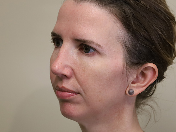 Rhinoplasty Patient 35 After 1