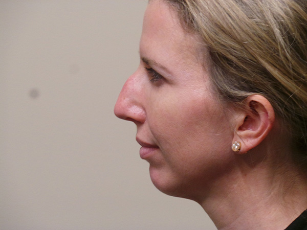 Rhinoplasty Patient 35 Before 2