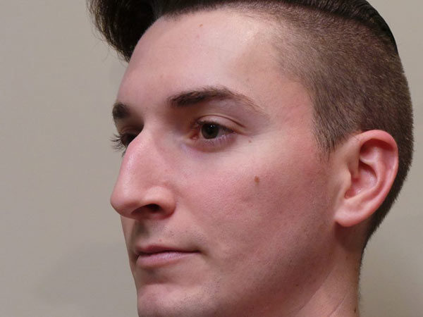 Rhinoplasty Patient 03 Before 1