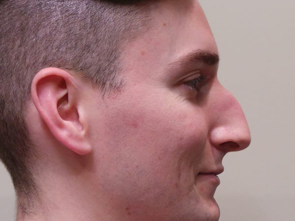 Rhinoplasty Patient 03 Before 2