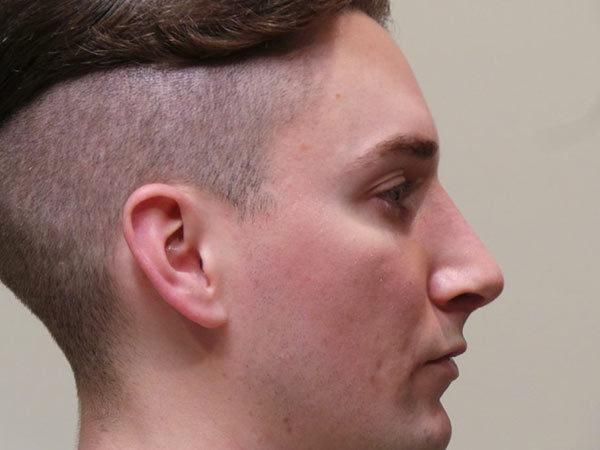 Rhinoplasty Patient 03 After 2