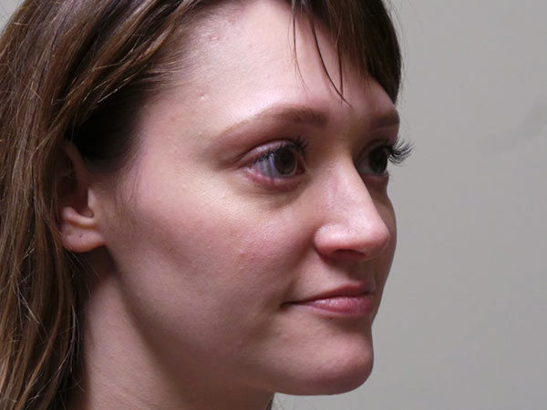 Rhinoplasty Patient 04 After 2
