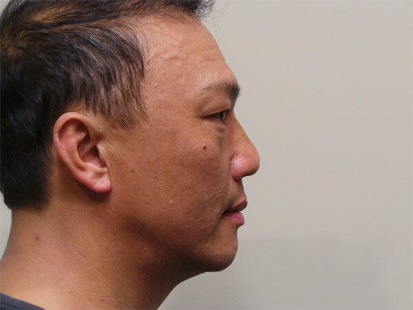 RHINOPLASTY PATIENT 13 Before 1