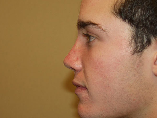 Rhinoplasty Patient 04 After 1