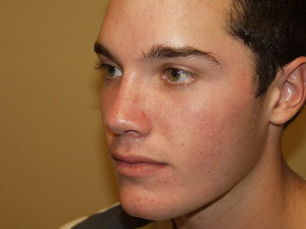 Rhinoplasty Patient 04 After 2