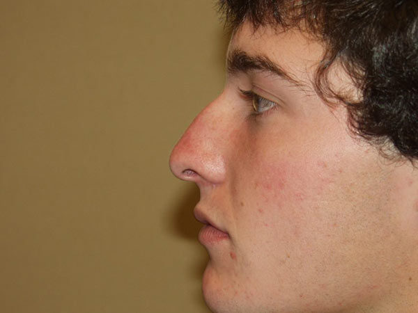 Rhinoplasty Patient 04 Before 1