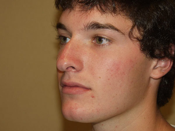 Rhinoplasty Patient 04 Before 2