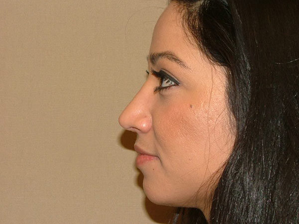 Rhinoplasty Patient 06 After 1