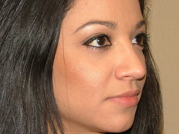 Rhinoplasty Patient 06 After 2