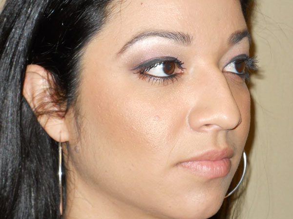 Rhinoplasty Patient 06 Before 2