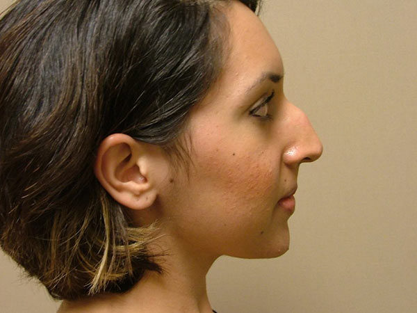 Rhinoplasty Patient 22 Before 1