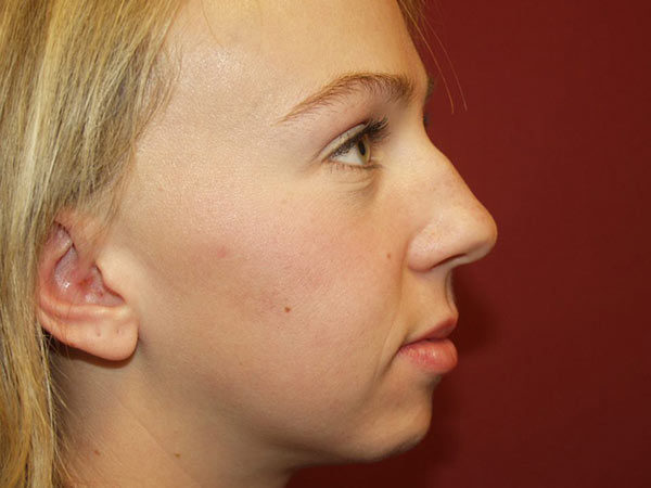 Rhinoplasty Patient 24 Before 2
