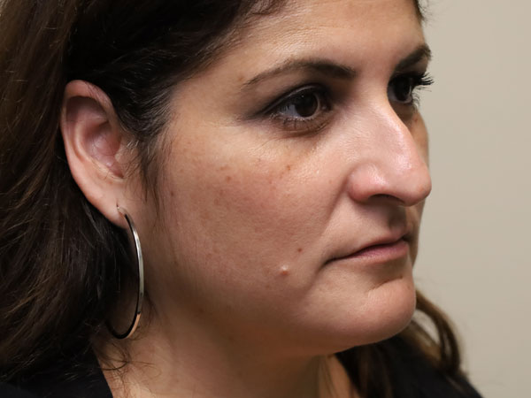 Rhinoplasty Patient 50 Before 1