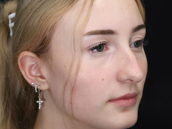 Rhinoplasty Patient 51 Before 1